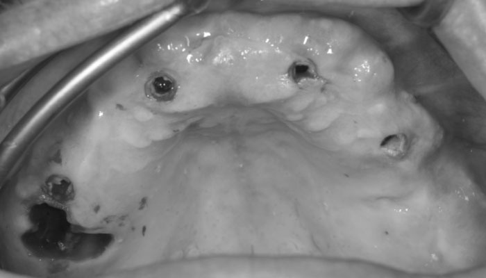 インプラントの埋入後の口腔内写真