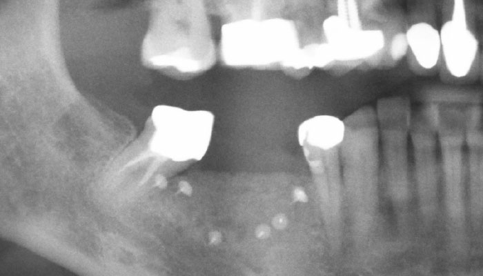 歯槽骨の増大手術後のレントゲン