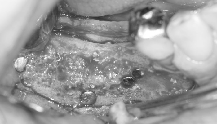 歯槽骨の増大手術後の経過