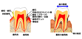 歯周病解説図